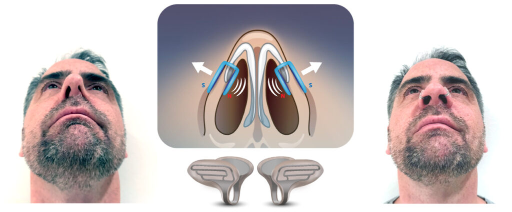 Image of How Nosewings Plugs Work With and Without Wearing